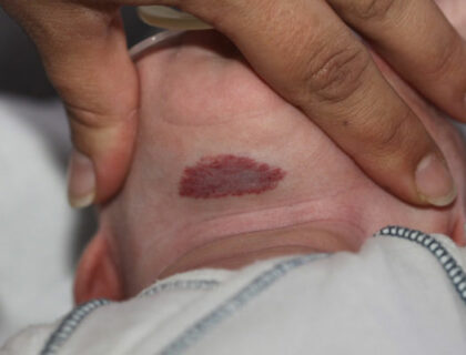 Emangioma Infantile